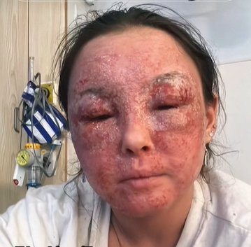 Foto mostra a jovem Beatrice Gaucahas durante sua crise de eczema mais profunda - Metrópoles