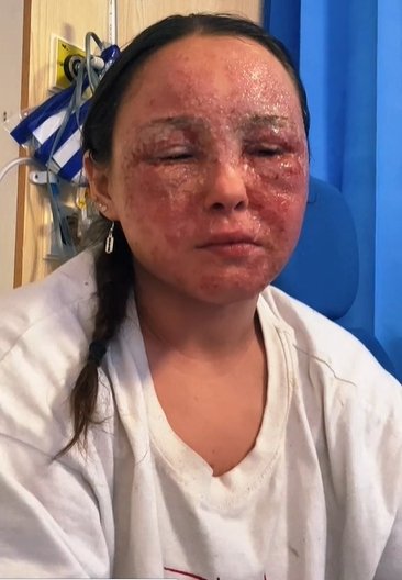 Foto mostra a jovem Beatrice Gaucahas durante sua crise de eczema mais profunda - Metrópoles