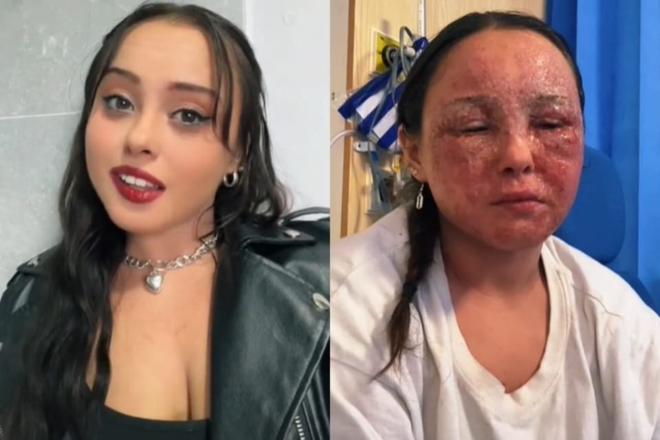 Montagem de fotos mostra o rosto de Beatrice Gaucahas com a crise de eczema e depois do tratamento