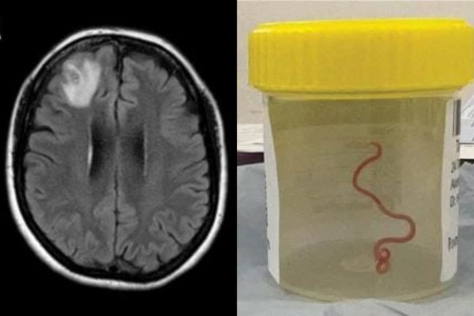 Montagem mostra lado a lado imagem de cérebro infectado e do verme que foi encontrado dentro dele