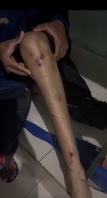 imagem colorida de perna machucada - Metrópoles