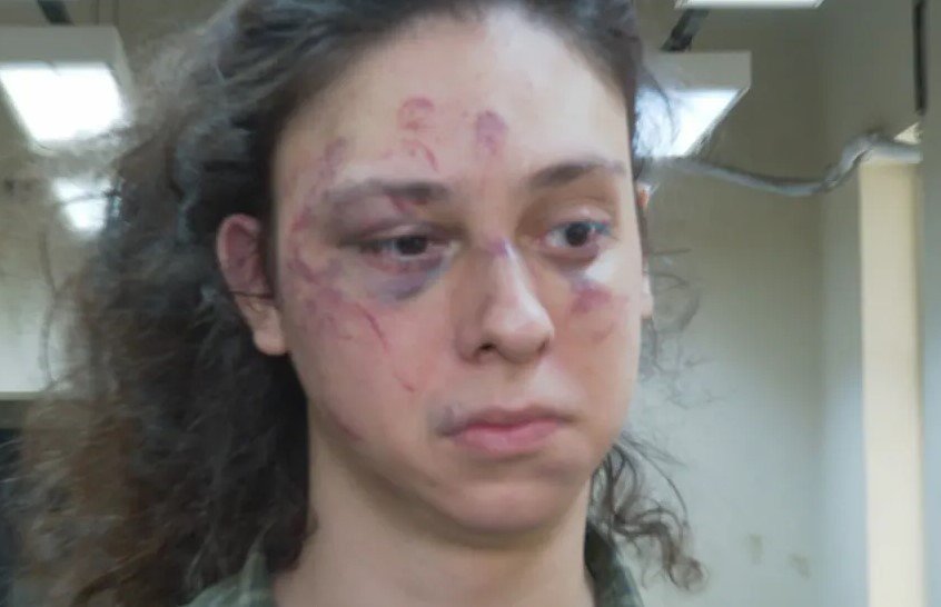 Foto colorida de rosto de Victor Meyniel após agressão que porteiro viu e não fez nada - Metrópoles