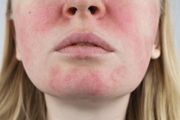 Foto de mulher loira com manchas vermelhas na pele causadas por rosácea - Metrópoles