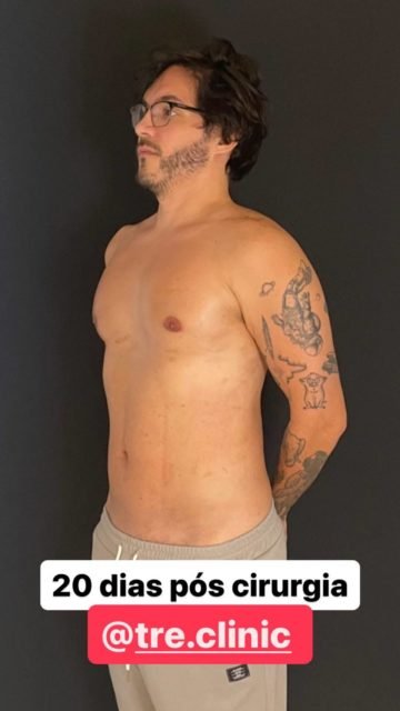 foto de eliezer sem camisa apos cirurgia - metrópoles