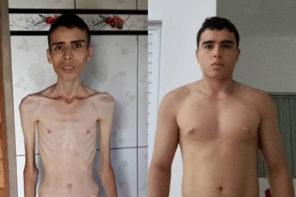 Foto colorida de um jovem sem camisa extremamente magro e com o corpo saudável - Metrópoles
