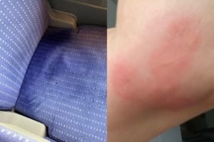 Foto colorida de um percevejo no assento e uma braço vermelho - Metrópoles