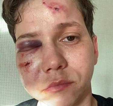 Imagem colorida dos hematomas da influencer Karol Eller, após sofrer homofobia - Metrópoles