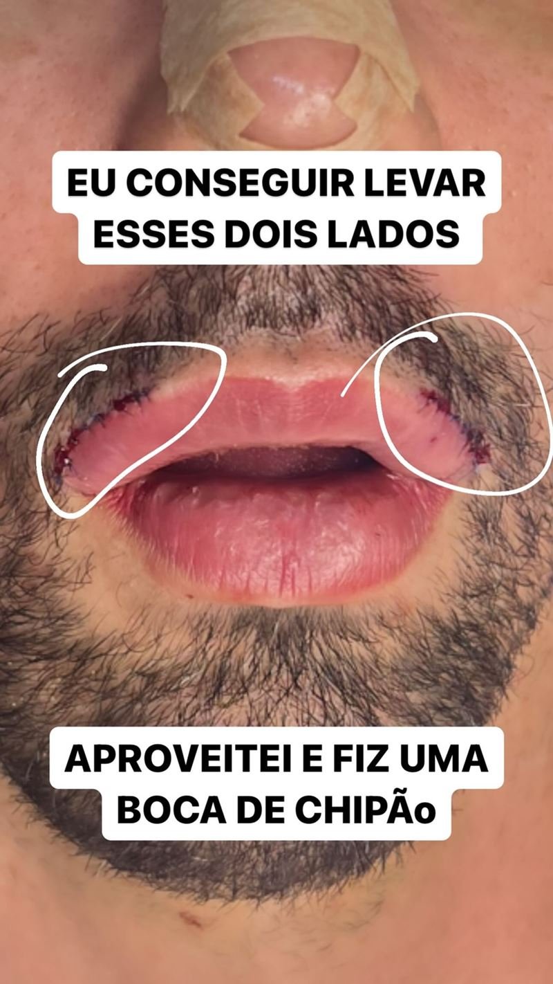 Antes e depois de Rico Melquiades: influenciador revela novo rosto