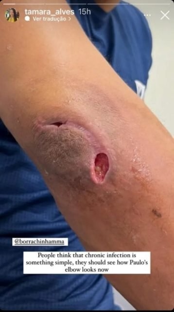 Paulo Borrachinha, lutador de UFC tem infecção no cotovelo - Metrópoles