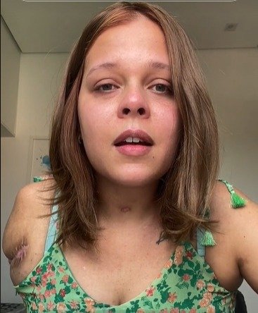 Foto mostra Bárbara Maia, jovem de Belo Horizonte que tem a síndrome antifosfolípide, doença autoimune que levou seu braço a ser amputado