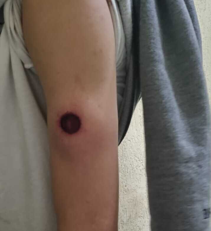 Em foto colorida bra&ccedil;o de homem branco com ferimento provocado por bala de borracha - Metr&oacute;poles