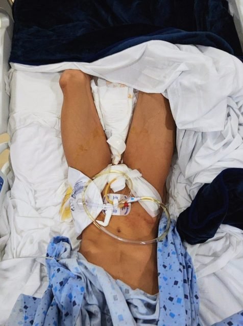 Foto mostra corpo de Layli Nullo com curativos em uma cama hospitalar