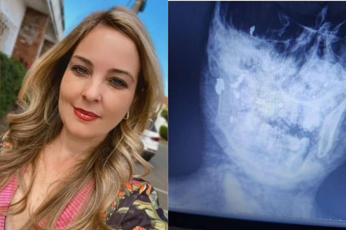 Montagem com duas imagens. À direita, foto da dentista, uma mulher loira e branca,que foi assassinada. À direita, imagem do exame de raio-x