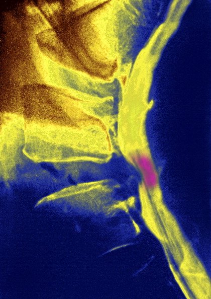 Imagem colorida de de exame de imagem que mostra nervo comprimido - Metrópoles