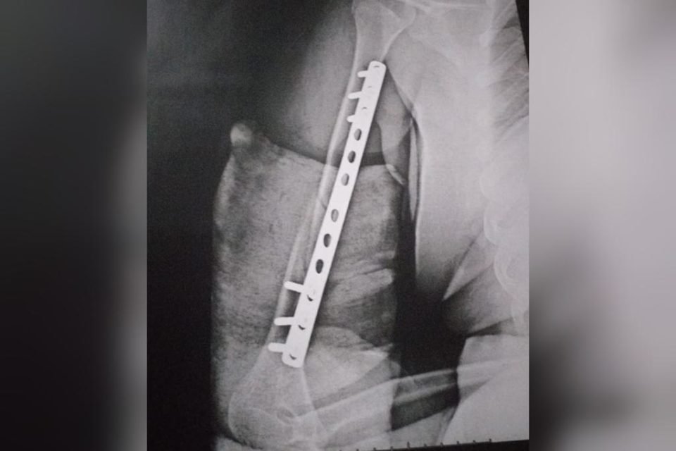 Imagem em preto e branco de um raio X do braço de um adolescente - Metrópoles