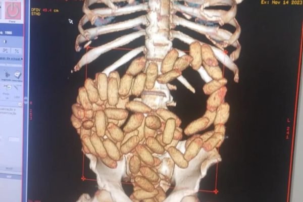 Foto colorida mostra tela de computador com raio-X mostrando tórax humano com cápsulas de cocaína bolivianos - Metrópoles