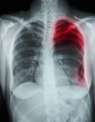 Imagem colorida de radiografia de peito com pneumotorax - Metrópoles