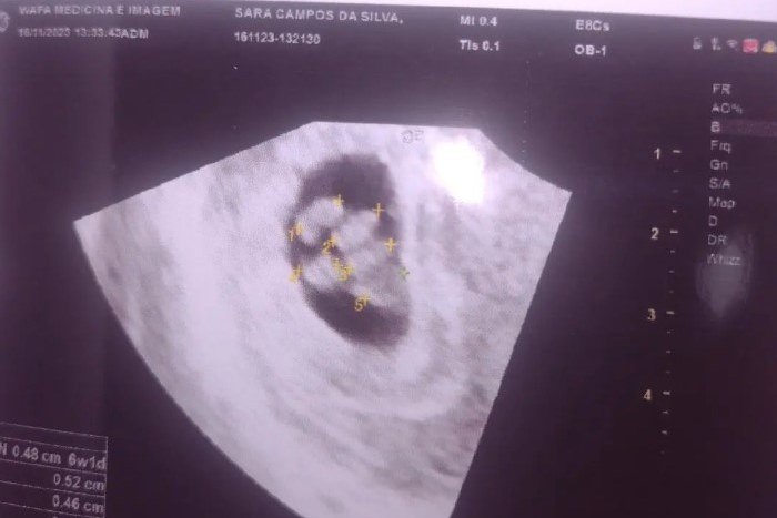 Imagem de ultrassonografia mostra gravidez de quíntuplos - Metrópoles