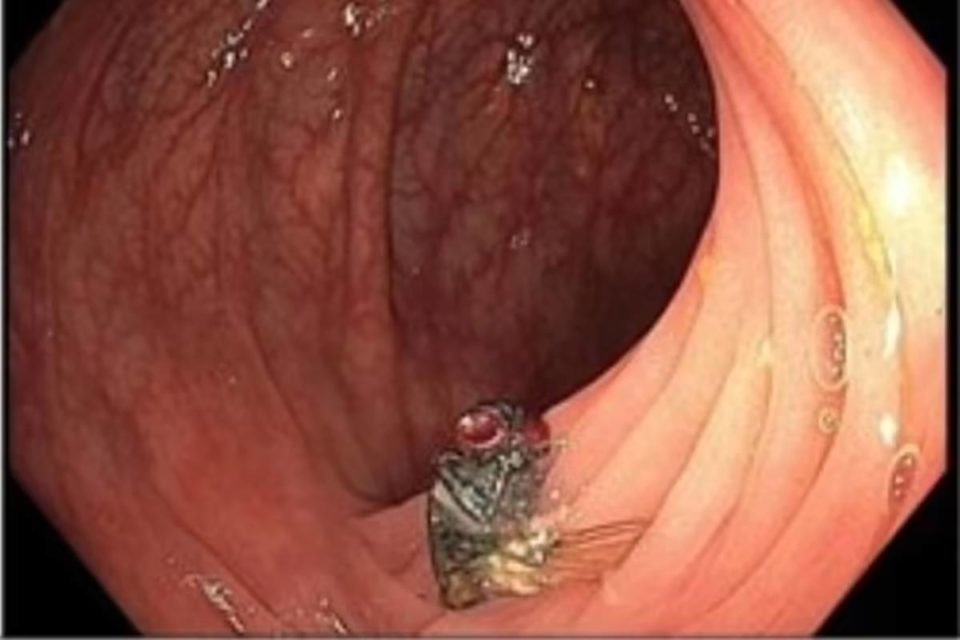 Imagem colorida de mosca dentro de estrutura no instestino - Metrópoles