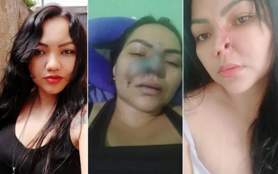 imagem colorida mulher perdeu parte nariz cirurgia com dentista