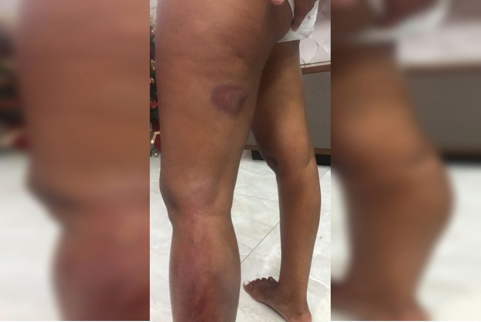 Mulher sofreu agressões nas pernas com pedaço de madeira
