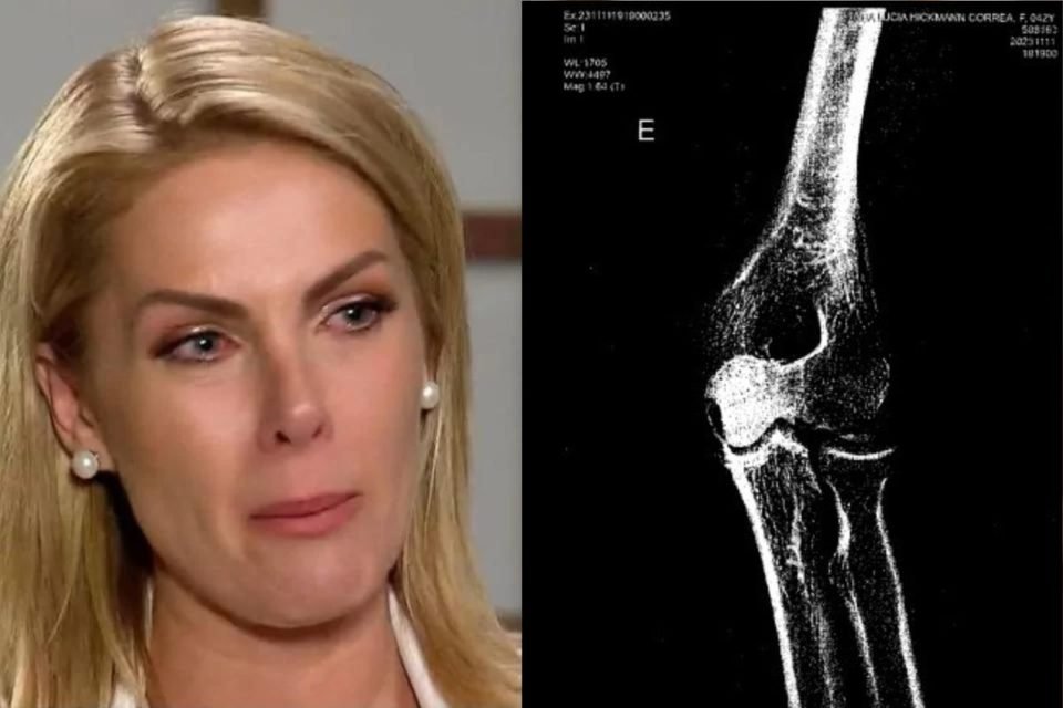 Montagem com duas imagens. À esquerda, apresentadora Ana Hickmann chorando. À direita, exame de raio-xe