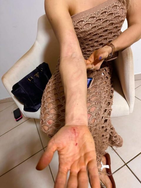 imagem colorida de lesões em mulher agredida por policial civil de Alagoas Cleyton Serpa