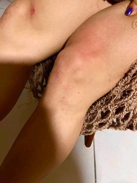Imagem colorida de mulher com as pernas feridas após agressão de policial civil de Alagoas, Clayton Serpa