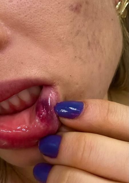 Imagem colorida de mulher com boca ferida após agressão de policial civil de Alagoas, Clayton Serpa