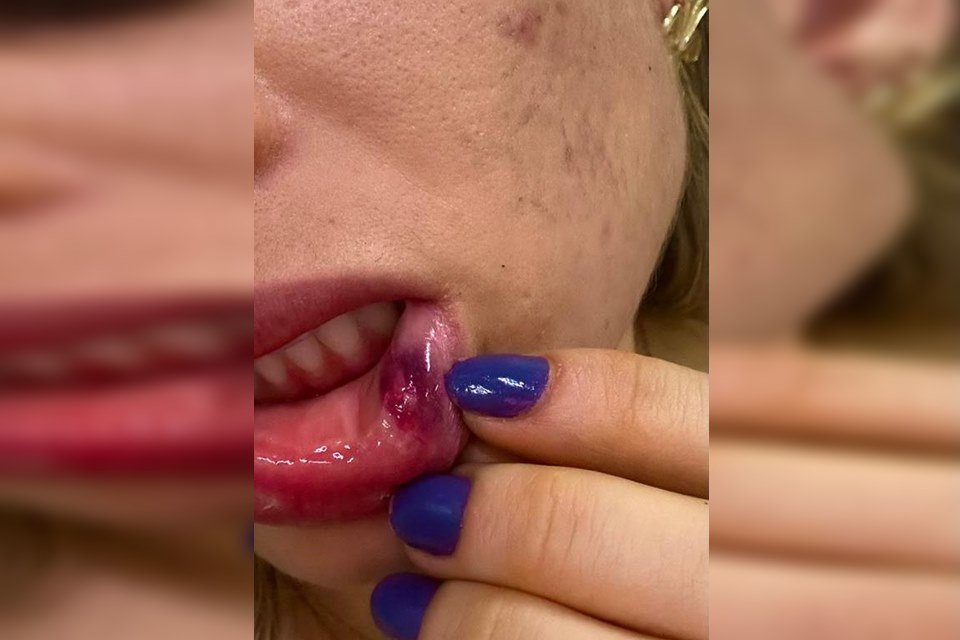 Imagem colorida de mulher com boca machucada após agressão de policial civil de AL, Cleyton Serpa