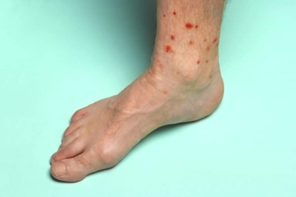 Imagem colorida de pessoa com pé inchado, comúlceras e feridas - Metrópoles