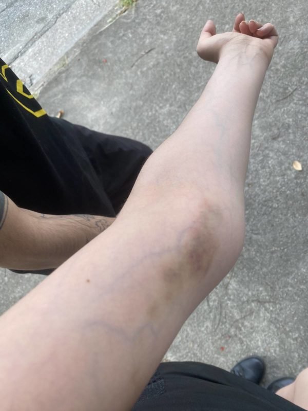 Foto colorida do hematoma da atriz Thiessa - Metrópoles