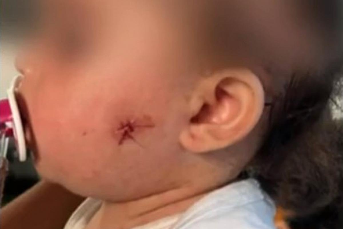 foto colorida de bebê com ferimento no rosto provocado por tiro de PM em São Paulo; policial usou airsoft