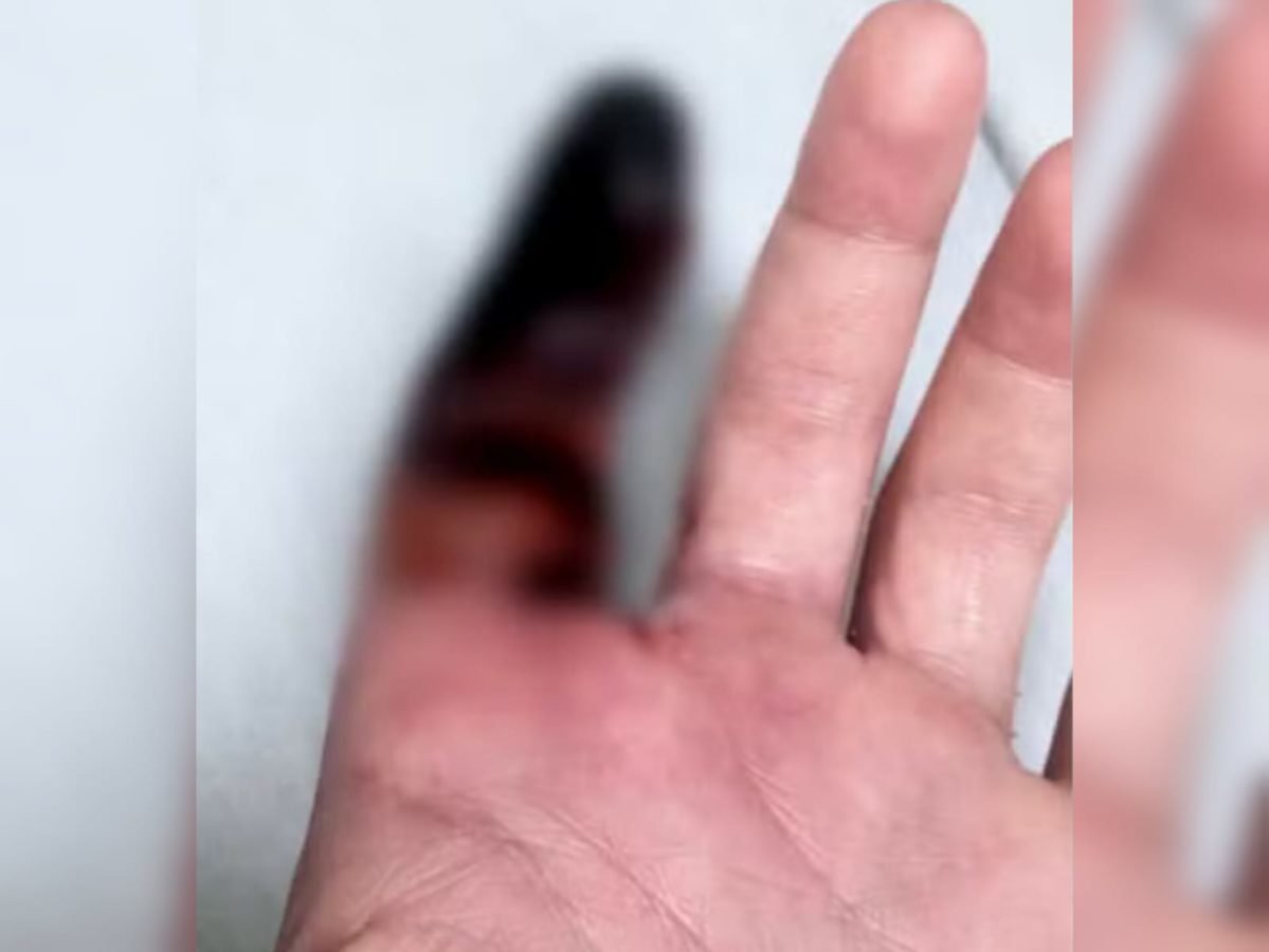 Homem picado por aranha venenosa na Praia Grande terá dedo amputado | Metrópoles