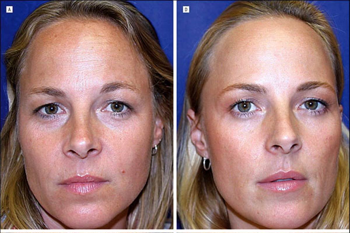 Foto mostra comparação da qualidade de pele de gêmeas que usaram botox