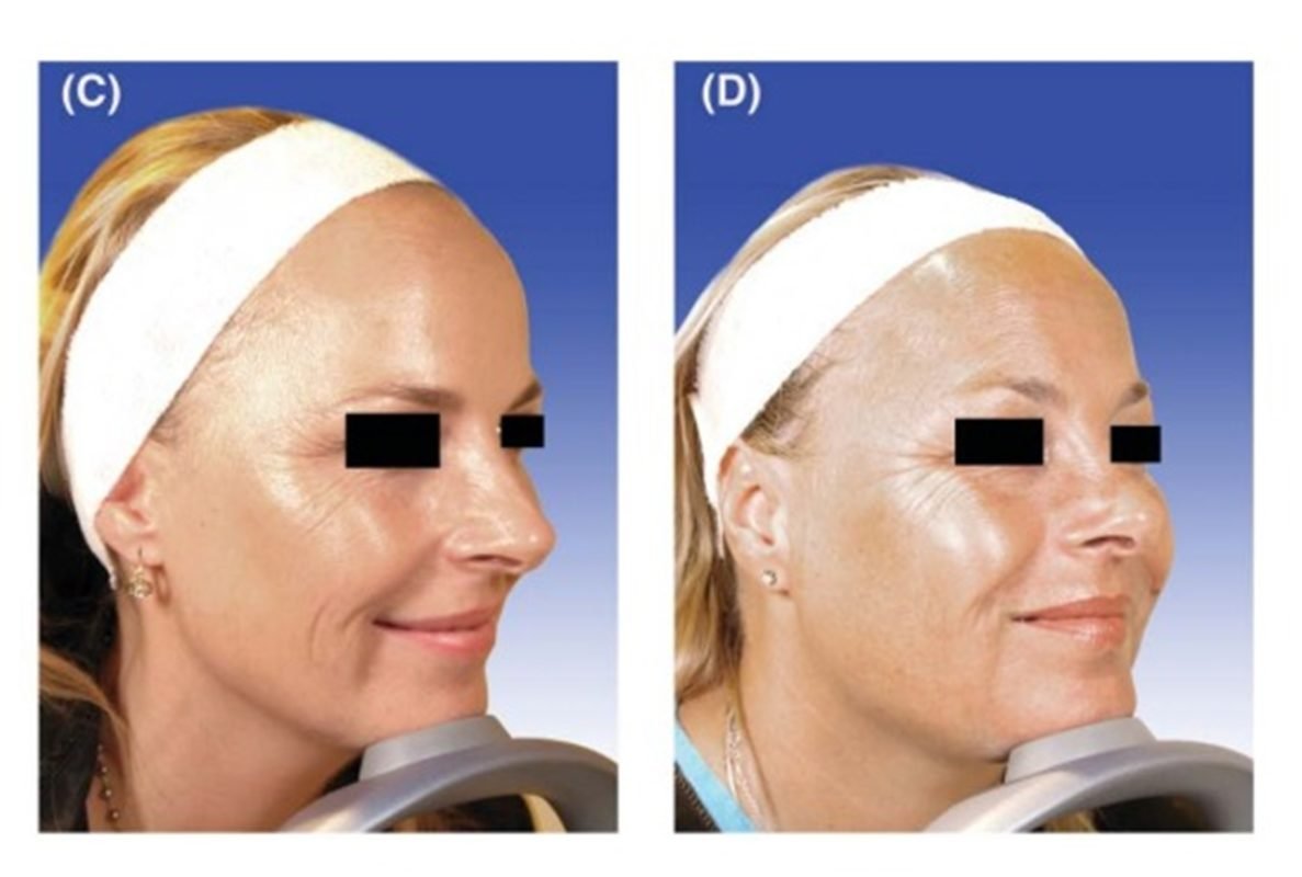 Foto mostra comparação da qualidade de pele de gêmeas que usaram botox