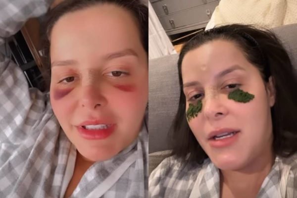 Maraísa mostra como está o rosto após acidente na piscina