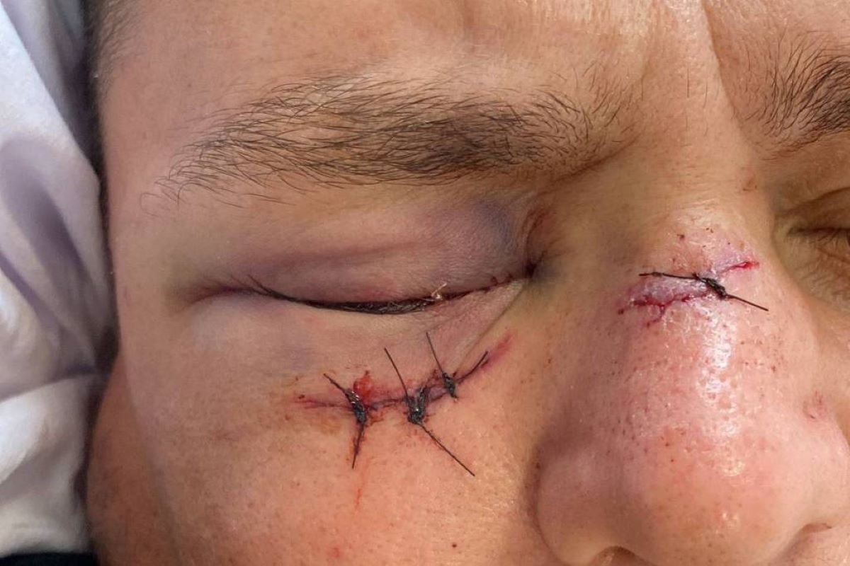 Imagem de homem com olho roxo e suturas na faca e no nariz - Metrópoles