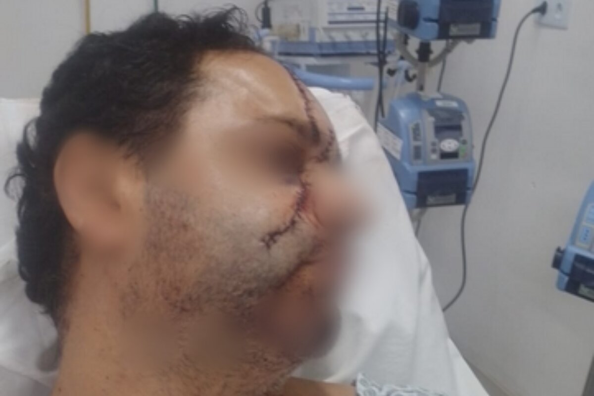 Em foto colorida homem com a cabeça de lado, em maca hospitalar, com o rosto costurado - Metrópoles