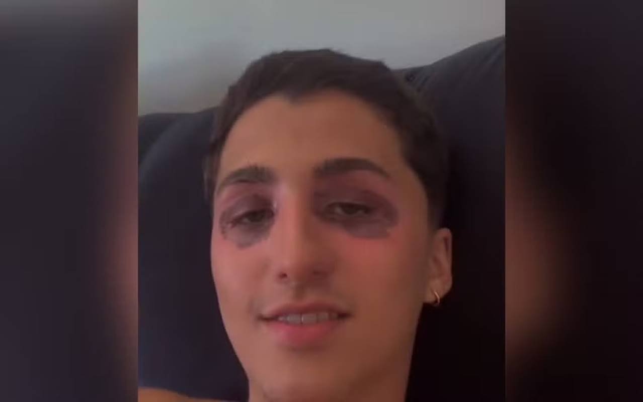 imagem colorida jovem olhos inchados apos uma semana