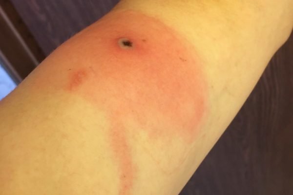 Braço de homem com ferida causada por Alaskapox - Metrópoles