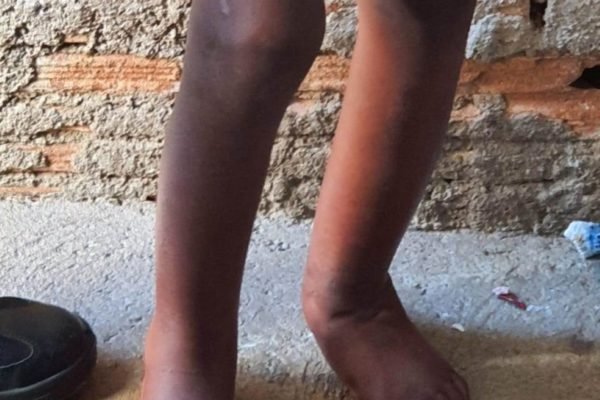 Imagem colorida mostra pernas de menino negro que era torturado pelo pai e família na cidade de Campinas em 2021 - Metrópoles