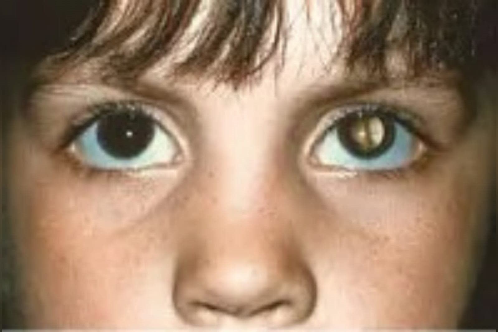 Foto mostra olhos de criança com retinoblastoma, com brilho anormal dos flashes - olho vermelho - Metrópoles