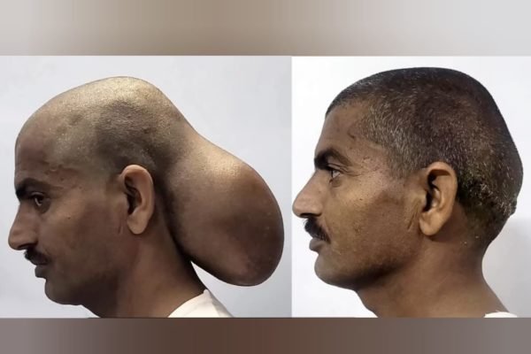 Foto mostra homem indiano com tumor de grandes dimensões por trás de sua cabeça - Metrópoels