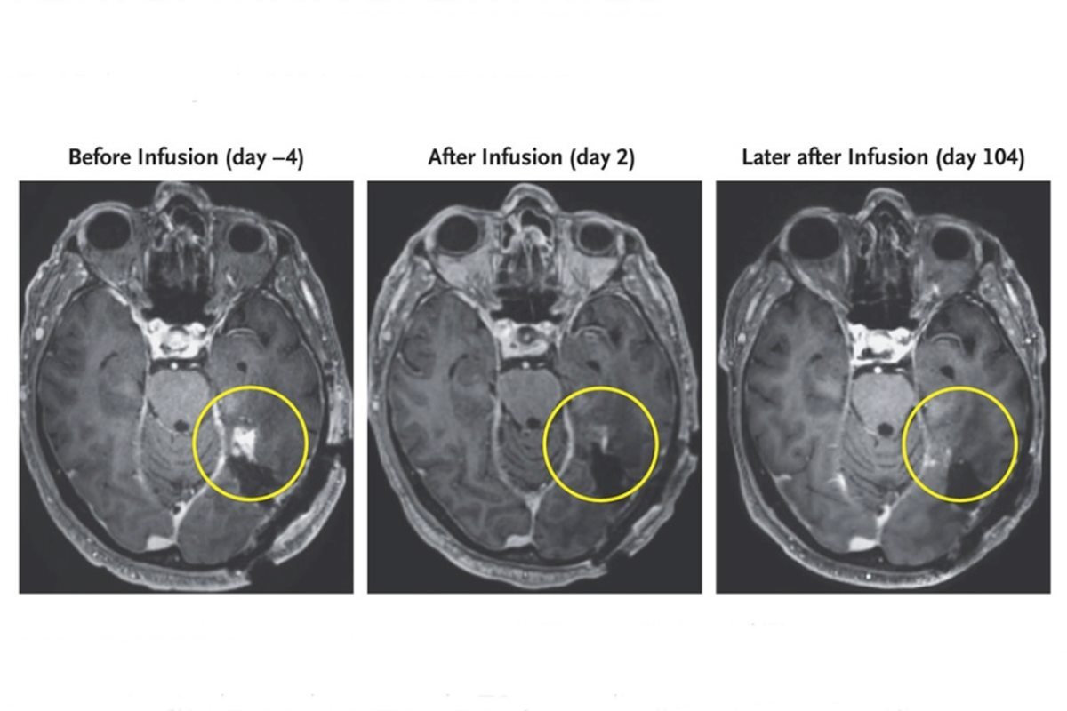 Três imagens de ressonância magnética mostram redução de tumor cerebral - Metrópoles