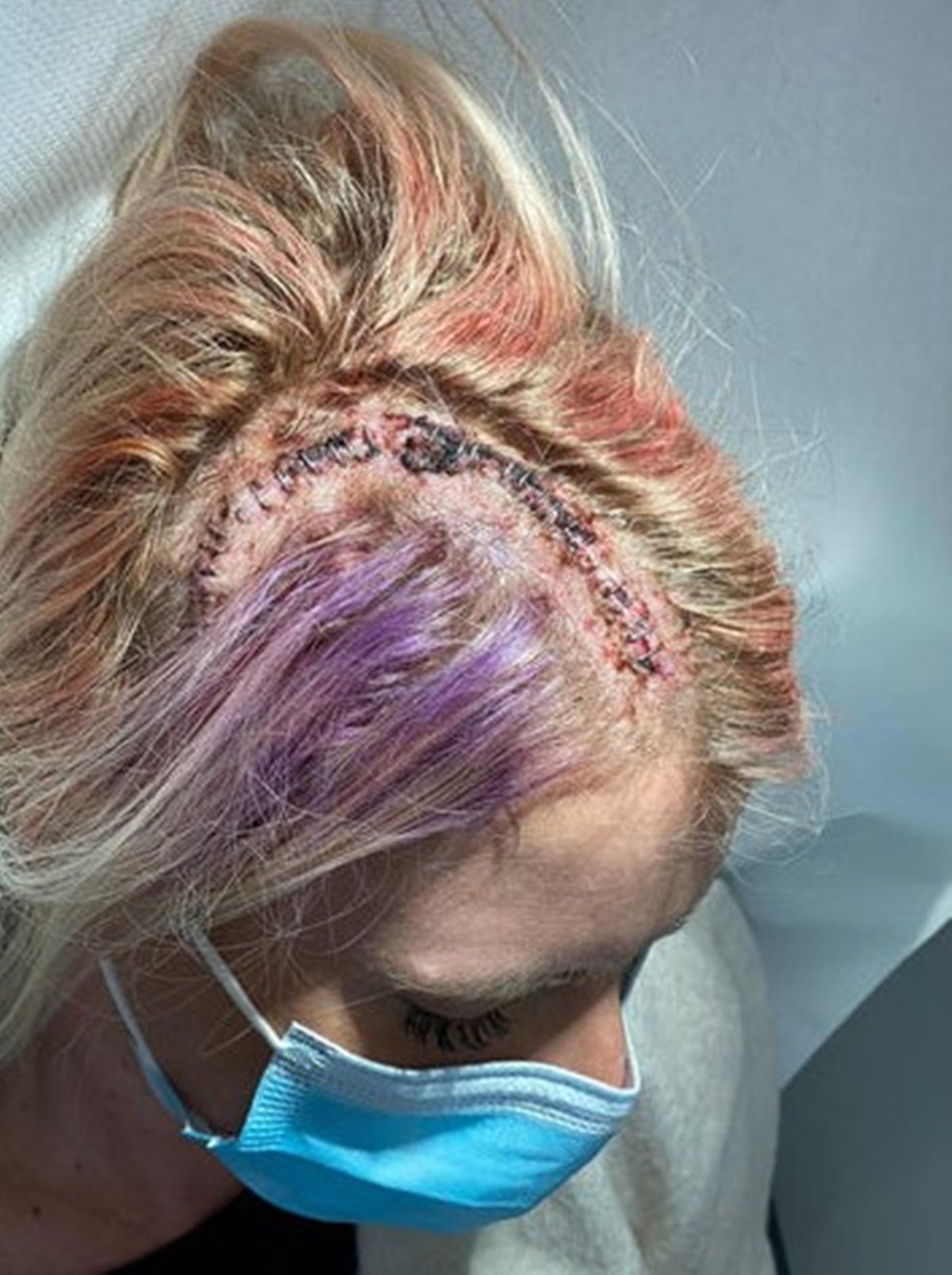 Imagem mostra mulher loira com cicatriz na cabeça - Metrópoles