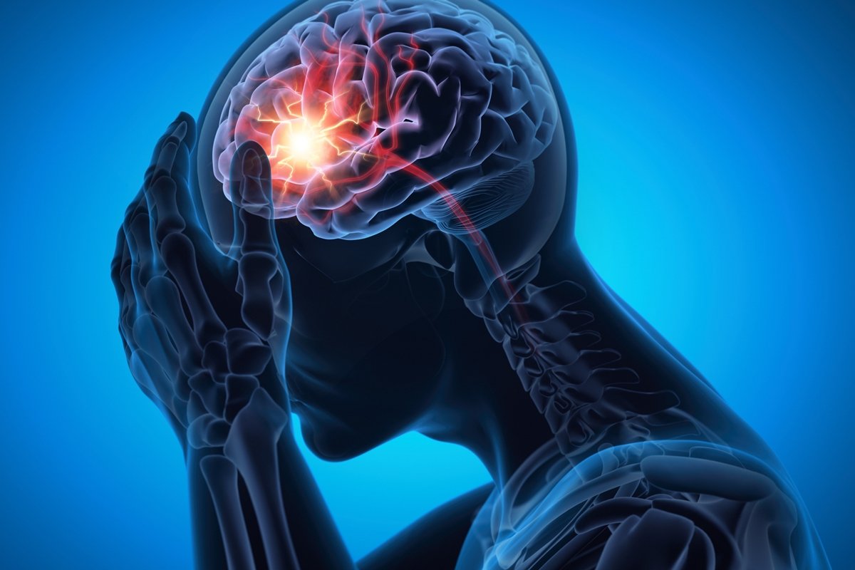 Ilustração de homem com forte dor de cabeça - Saiba como reduzir o risco de AVC e cuidados essenciais para prevenção - Metrópoles