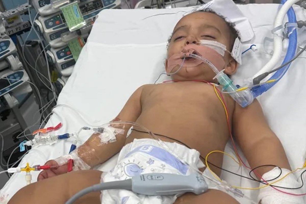 Bebê perde metade da língua após confundir soda cáustica com leite